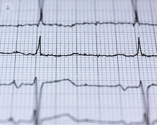 electrocardiograma-es