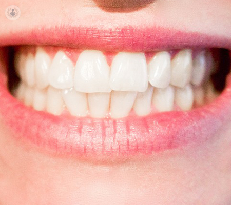 ¿Qué debemos saber sobre las carillas dentales?