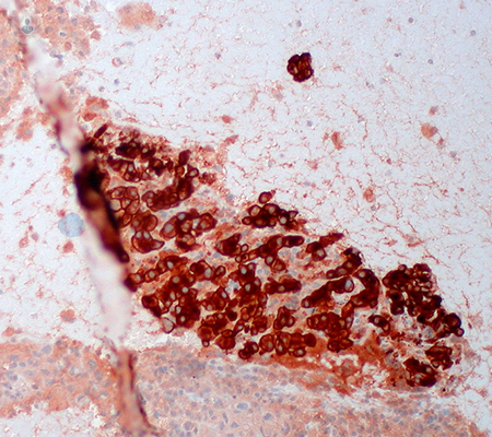 melanoma