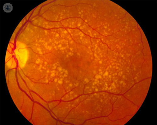 Degeneración macular, la patología ocular de las personas mayores