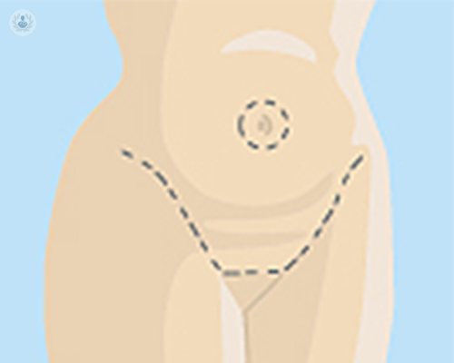 abdominoplastia