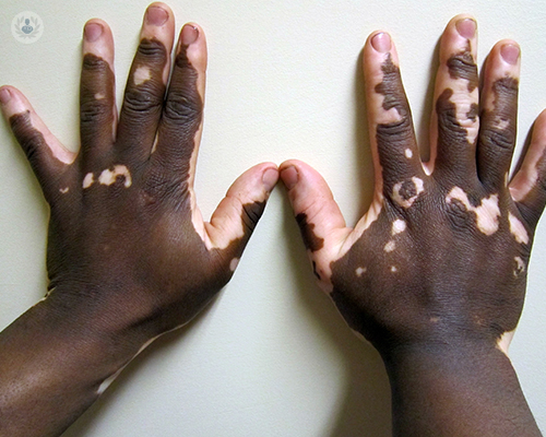 manos-con-vitiligo