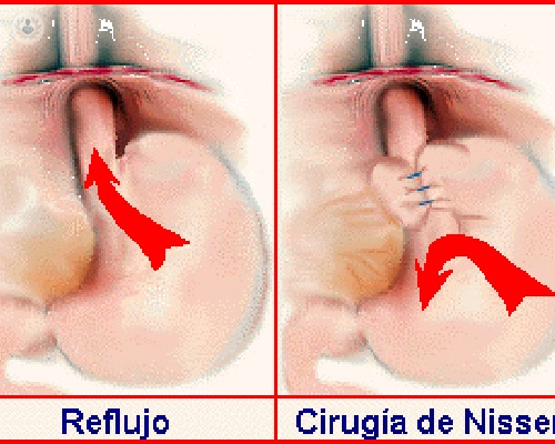 reflujo-gastroesofagico