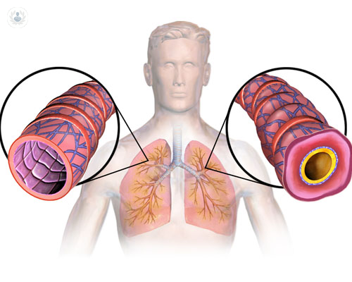 Asma bronquial: la inflamación de los bronquios