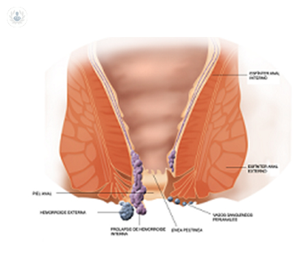imagen-detallada-de-una-hemorroide