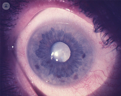 ojo-con-catarata