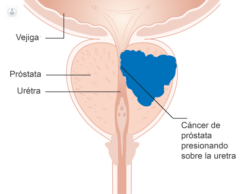 La estadística da esperanzas a enfermos de cáncer próstata