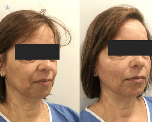 hilos-tensores-hilos-magicos-hilos-pdo-lifting-estetica