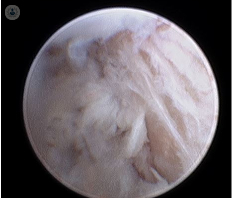 artroscopia-temporomandibular