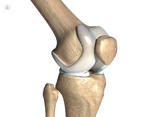 Prótesis de rodilla para la artritis y artrosis avanzadas