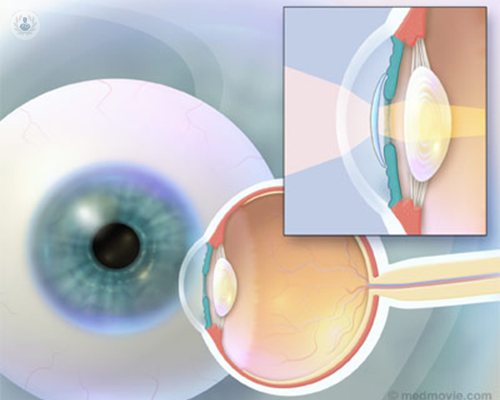 lentes-intraoculares