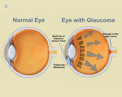 ¿Qué es la Cirugía de Glaucoma mínimamente invasiva?