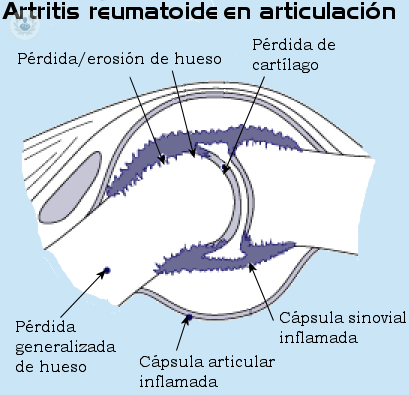artritis-reumatoide