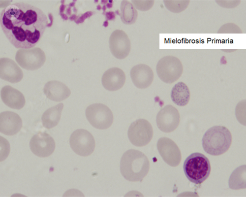 ¿Qué son las Neoplasias Mieloproliferativas y como se diagnostican?