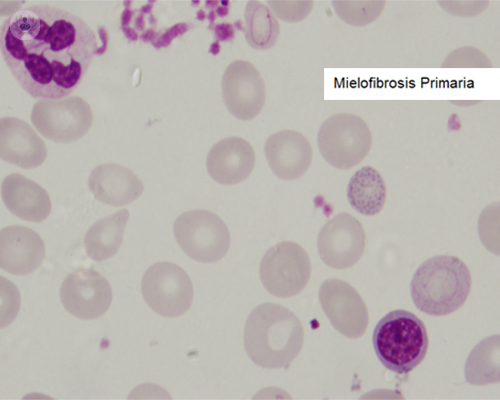 neoplasias-mieloproliferativas