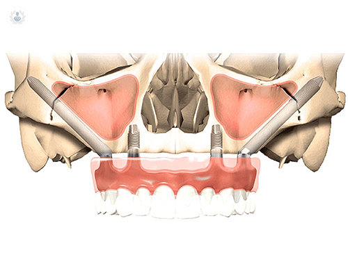 implantes-cigomaticos