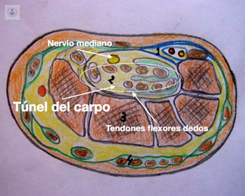 sindrome-del-tunel-carpiano