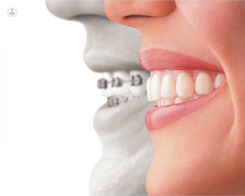 Invisalign VS ortodoncia convencional