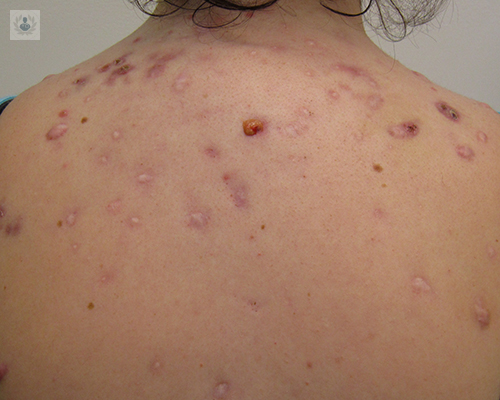 acne-cicatrices-dermatologia-piel