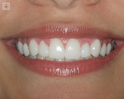 Diez preguntas frecuentes sobre implantes dentales
