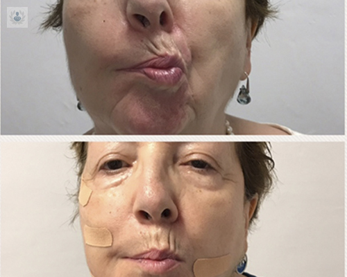 paralisis-facial
