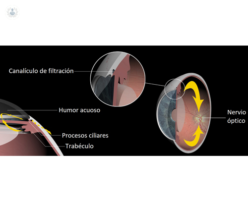 Glaucoma o aumento de la presión intraocular: importancia del diagnóstico precoz y opciones de tratamiento