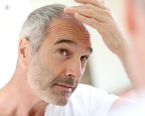 Pérdida de cabello o alopecia: cuándo acudir al especialista