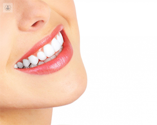 Preguntas frecuentes sobre blanqueamiento dental