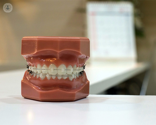 Tipos de ortodoncia y sus beneficios