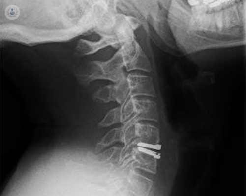 hernia-de-disco-cervical