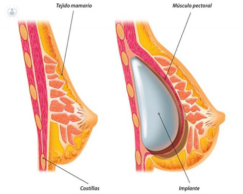implantes-mamas-grafico