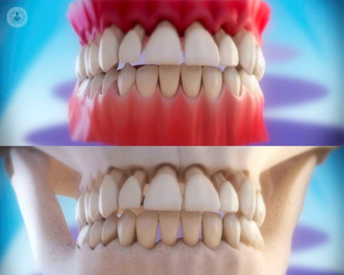 Enfermedad periodontal: frénala a tiempo