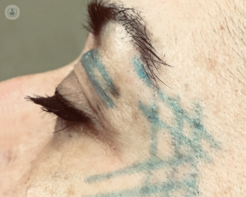 rostro-hilos-tensores