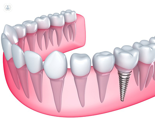Tipos y ventajas de los Implantes Dentales