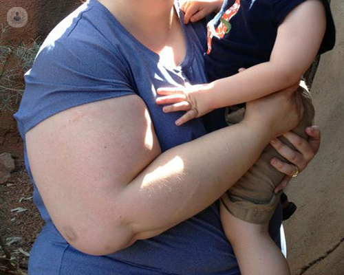 lipedema-en-los-brazos