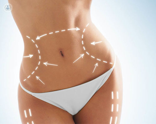 liposuccion-celulitis