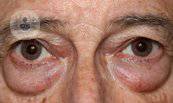 Cirugía de los párpados, bolsas y cantos oculares: blefaroplastia