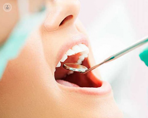 dientes-perfectos-con-implantes