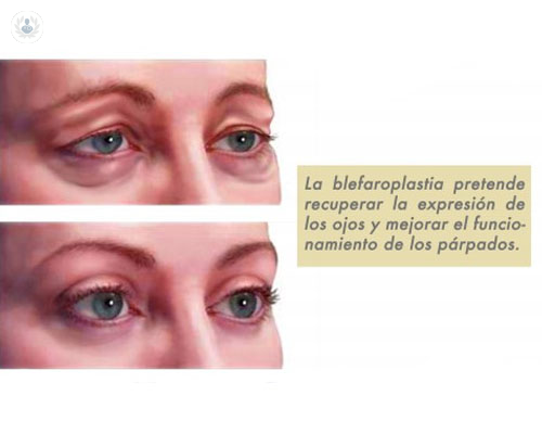 blefaroplastia-cuando-realizarla