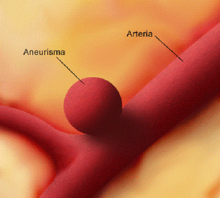 Infórmate sobre los riesgos de tener un aneurisma de aorta