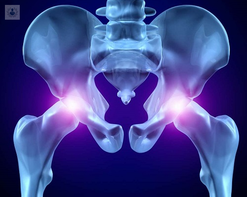 Opciones de tratamiento para la artrosis de cadera