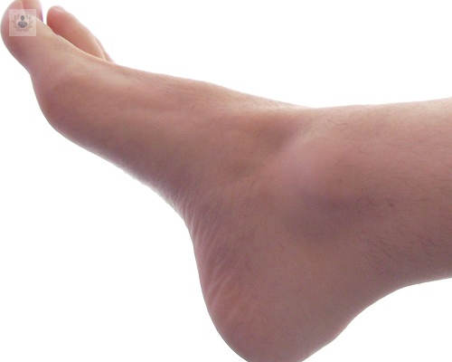 cirugia-percutanea-del-pie-neuroma-de-morton