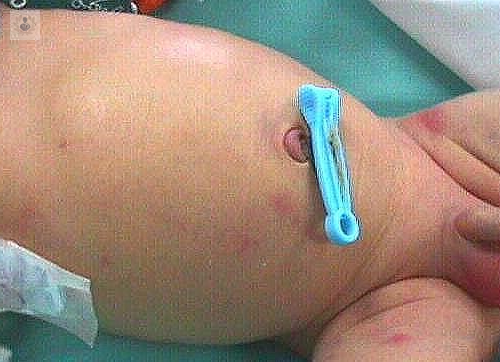 megacolon-congenito-etiologia