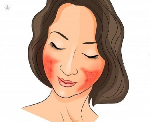 rosacea-causas