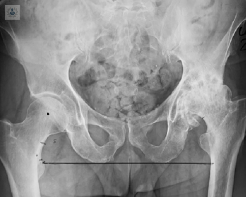 Causas de la artrosis de cadera y tratamiento por prótesis