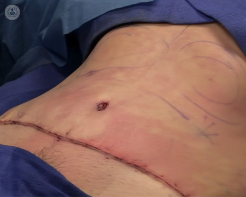 Abdominoplastia o lipectomía de abdomen
