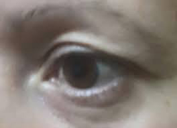 cirugia de parpados y bolsas