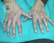 Tratamiento de manchas y lesiones pigmentadas con láser