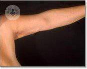 braqioplastia