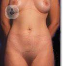 meloplastia-crural